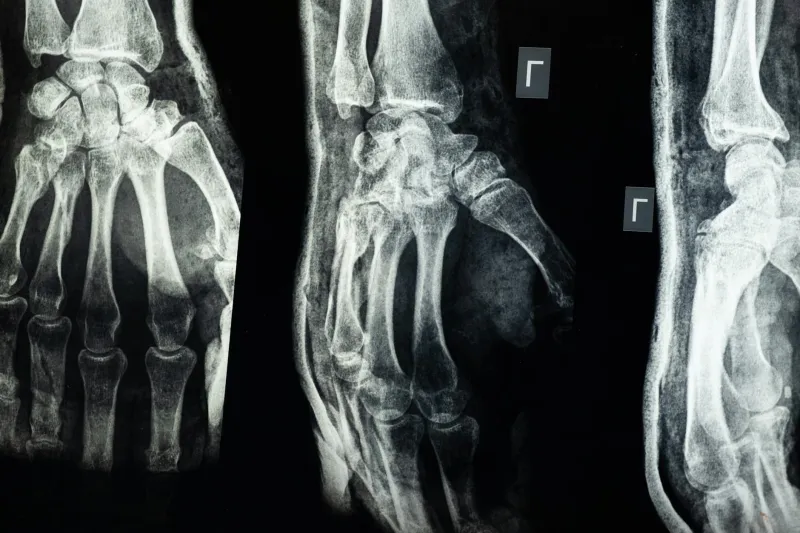 When Breaking Your Leg Meant Breaking Your Life: The Terrifying Reality of Bone Injuries Before Modern Medicine